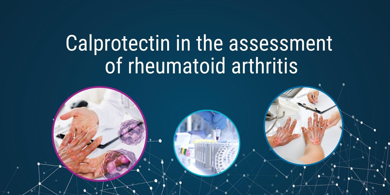 Calprotectin in rheumatoid arthritis