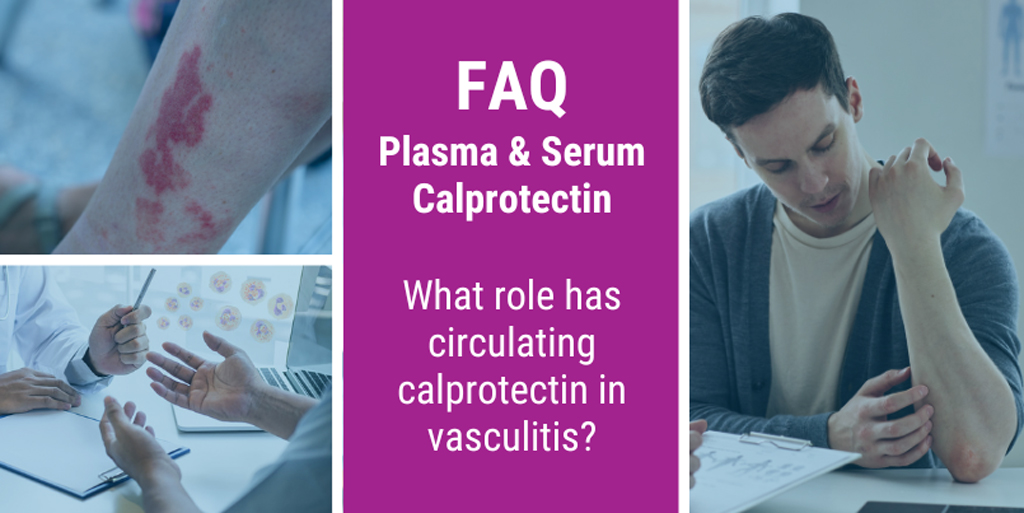 FAQ: What role has circulating calprotectin in vasculitis?